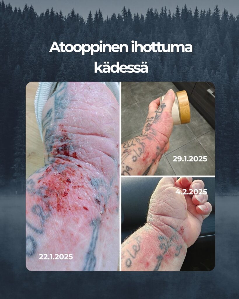 Kivulias atooppinen ihottumani käsissä ja miten nopeasti Saaren Taika tuotteet ovat tuoneet helpotusta.