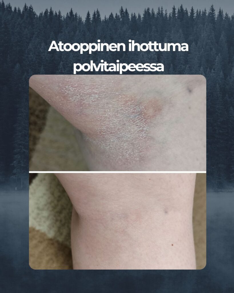 Metsämikrobi vartalovoide ihan totaalisesti pelasti mun polvitaipeen kun mikään muu voide ei ollut vielä siihen auttanut. Vaatteet sattui, käveleminen sattui mutta jo parin käyttö kerran jälkeen kipu lähti ja kuivuus alkoi kadota.