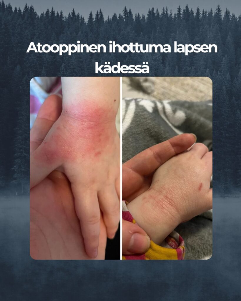 Pistin teille muutama viikko sitten kyselyä, löytyykö teiltä tuotteita mun rakkaan 2-vuotiaan pahaan atooppisen ihottuman hoitoon. Olen käyttänyt varmaan satoja euroja hänen ihottuman hoitoon, mikään ei tuntunut helpottavan ihoa kun hetkeksi ja taas menee pahaksi iho. Ennen teidän yhteydenottoa iho meni todella punaiseksi, kuoriutui iho, haavaiseksi raapimisen jäljiltä ja yöt meni raapiessa ihoa. Aloin olemaan todella surun murtama, kun näki että pienellä sattuu. Hän itki kun laittoi rasvaa tai kasteli vedellä. Päätin että kokeilen teidän tuotteita, ennen kuin menen uudestaan lääkäriin asian suhteen. Ostin kokeiluun ihottumaan Sheavoi Karitevoidetta sekä Saariston suolasaippuaa. Parin käyttökerran jälkeen aloin nähdä ihon parantumisen prosessin käynnistyvän. Kova pakkanen toi hiukan takapakkia ihottuman selättämiseen, mutta iho alkoi mennä parempaan suuntaan. Kiitos kiitos teidän tuotteiden, lapsi ei enää raavi käsiä öisin ja alkaa ihottuma alueen tilalle alkaa näyttää normaalilta iholta!! suolasaippuaa ei ärsytä ollenkaan hänen ihoa ja iho on aina sen käytön jälkeen ihanan pehmeä. Shea voidetta on ihana käyttää ja lapsi ei enää itke rasvan laiton aikana. Olen todella onnellinen, että teidän tuotteet auttoi pientä rakastani. Kiiitos! Laitan kuvat lapsen käsistä. Ensimmäinen kuva on joulukuusta, harmi kun en halunnut ottaa kuvia hänen ihottumasta silloin kun iho oli tosi rajun näköinen. Toinen kuva on otettu 2 viikon käytön jälkeen.