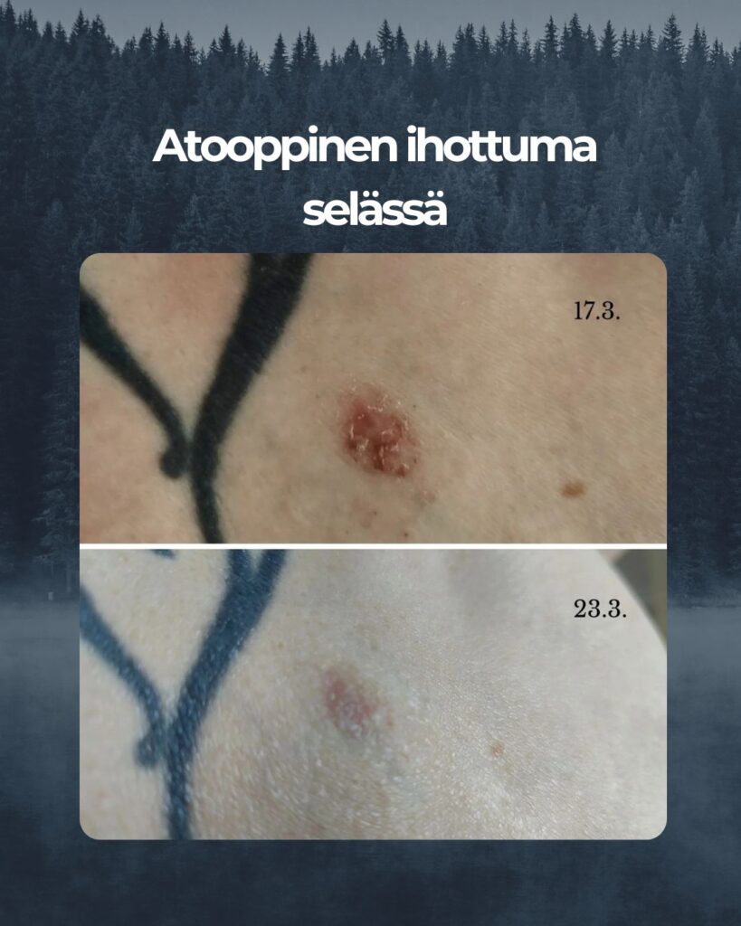 Selässä oleva atooppisen ihottuman laikku joka on tullut paremmaksi Saaren Taika tuotteilla.
