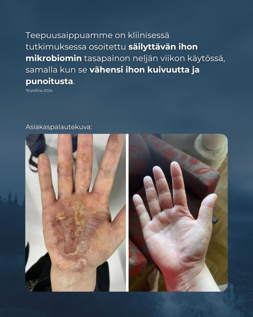 Teepuusaippuamme on kliinisessä tutkimuksessa osoitettu säilyttävän ihon mikrobiomin tasapainon neljän viikon käytössä, samalla kun se vähensi ihon kuivuutta ja punoitusta.
