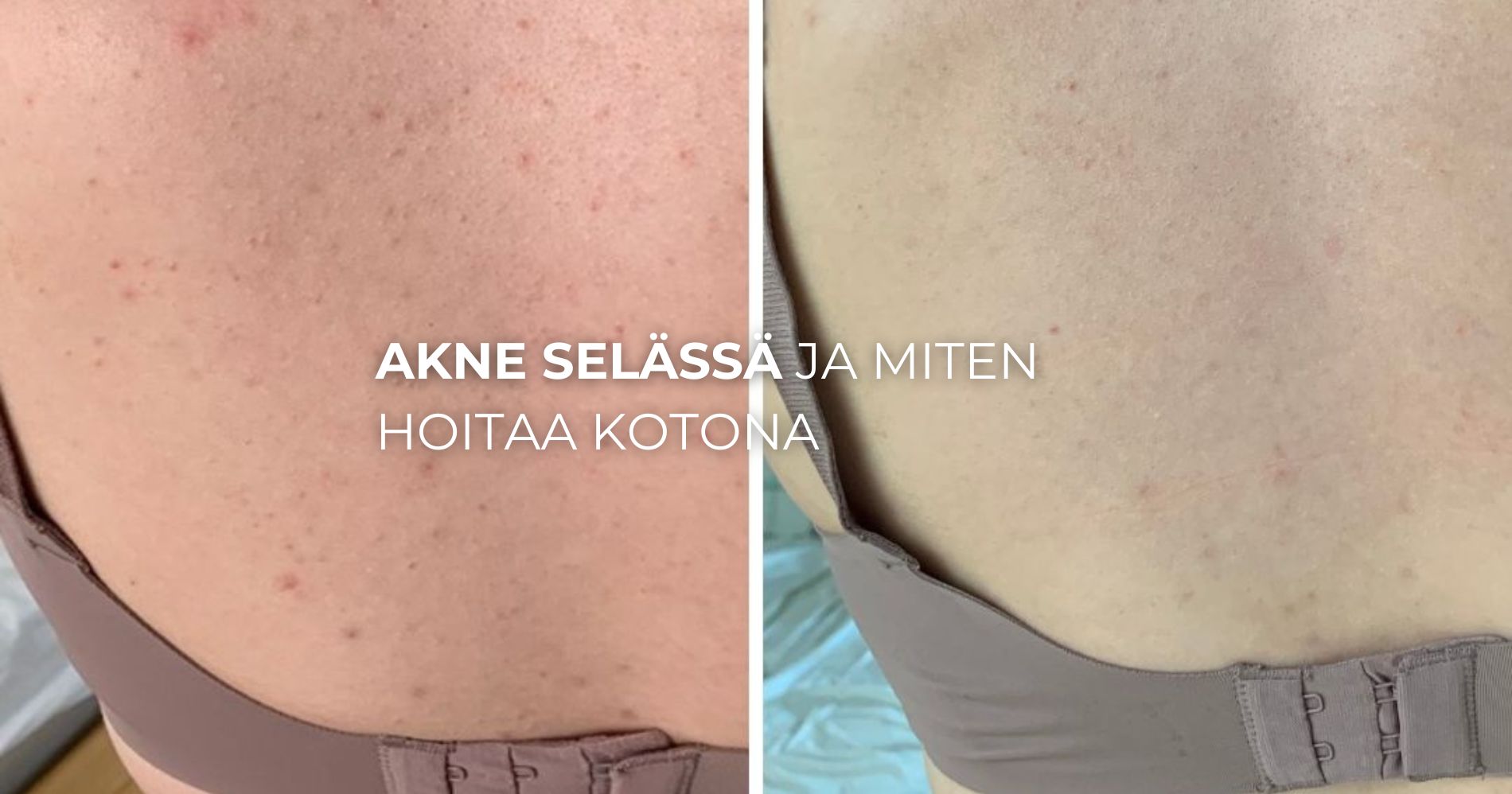 Akne selässä ja hoito