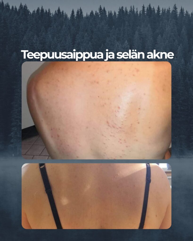 Asiakaspalaute Teepuusaippuan tehosta selkäakneen: "42-vuotias, 3 lapsen äiti. Olen kärsinyt aina hormonaalisesta aknesta, selässä enimmäkseen. Kesäisin myös dekolteen alueella. Kauhulla aina odotan tulevia kesiä ja juhlia kun iho on mitä on eikä mikään ole auttanut. Olen saanut eri lääkekuureja, ostanut voiteita, ollut syömättä sitä sun tätä. Koko netti selannut läpi löytämättä kuitenkaan toimivaa konstia tähän niin kiusalliseen ongelmaan. Tänä keväänä ostin Saaren taika teepuusaippuan ja ajattelin että koitanpa nyt kun sitä niin kehutaan. Tämä muutos vaati jokapäiväisessä käytössä, yhden saippuan. Alkukesästä aloitin käytön ja nyt on iho todella hyvä. Kiitos Saaren Taika että voin taas käyttää toppeja ja käydä uimassa."