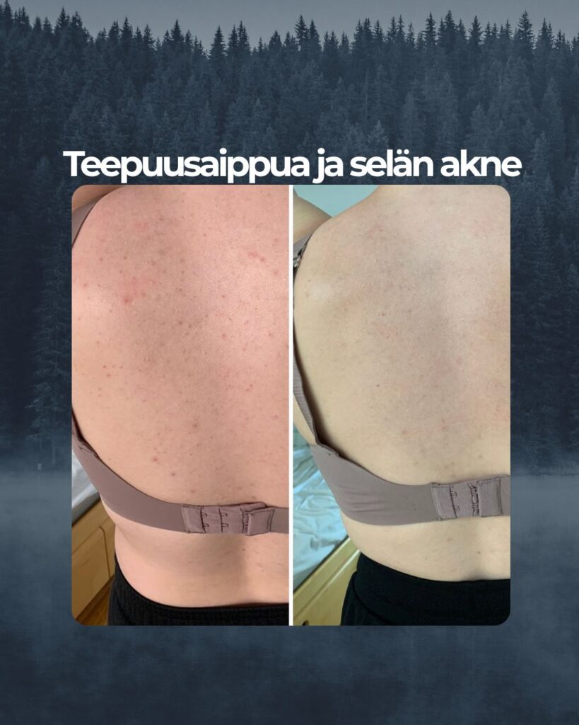 Asiakaspalaute Teepuusaippuan tehosta selkäakneen: "Selässä olevaan akneen ei ole muut tuotteet auttaneet. Selkä kutisi kokoajan ja puski näppyä. Kuvissa välissä muutama kuukausi teepuusaippuan käyttöä. Kutina loppui heti ekan pesukerran jälkeen ja näpytkin hävisivät pitkälti. En vaihtais Saaren Taian Teepuusaippuaa mihinkään❤️"