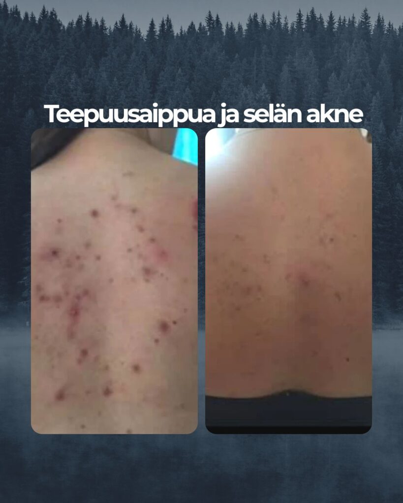 Kuvapalaute: Selän akne rauhoittui Saaren Taika Teepuusaippualla.