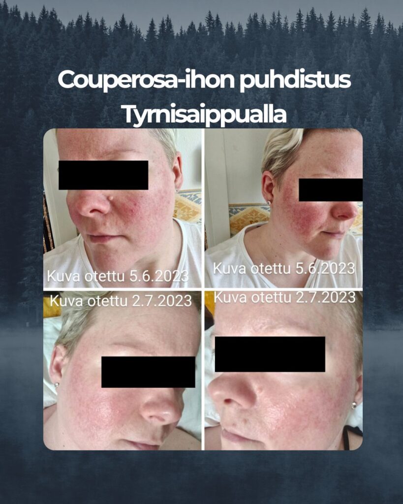 Kuvapalaute: Hei, ostin reilu kk sitten Tyrni Luksus Spa saippuan ja olen todella tyytyväinen siihen. Iho on osin rasvainen, ja talvella etenkin kuiva. Lisäksi on Couperosa ja ruusufinni tullut siihen vielä kiusaksi. Heti ensimmäisten pesujen jälkeen ihon pinta ei ole enään niin kuiva/ kireän oloinen. Ja kiilto on tullut takaisin. Olen juuri täyttänyt 40-v ja ajattelin jo, että kärsin tästä eikä apua ole. Sitten luin tästä Saaren Taika Tyrni Luksus Spa saippuasta ja muiden käyttäjien kokemuksia ja päädyin siihen, vaikka aktiivihiili teepuusaippuakin kuulosti houkuttelevalta (ehkä kokeilen sitäkin vielä), enkä ole katunut. Punoitus on vähentynyt, ja näppyjä ei tule enään niin paljon. Iho ei kutise enään niin juurikaan ja muutenkin se on huomattavasti rauhoittunut. Suuret kiitokset, ja lämmin suositus näihin tuotteisiin minulta.