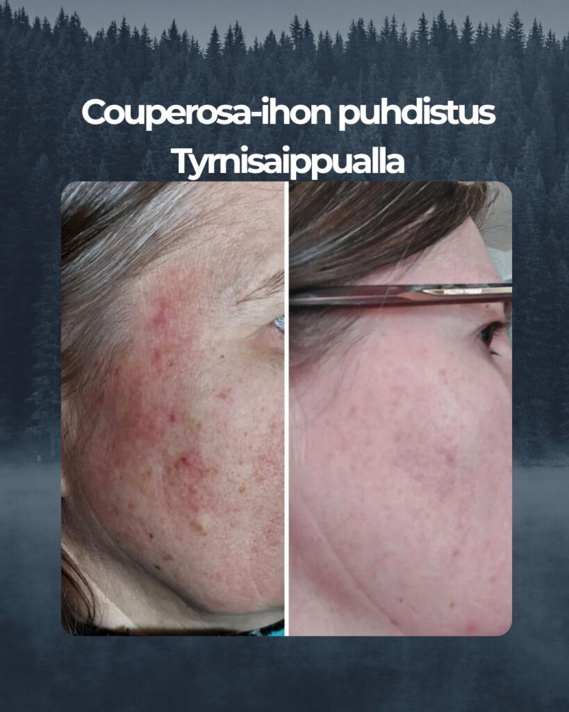 Kuvapalaute: Moi. Liitteenä kuvat ennen ja jälkeen tuotteidenne käytön. Tyrni Luksus Spa saippua ja Rauhoittava Hoitovoide todella toimivat, kiitos siitä!