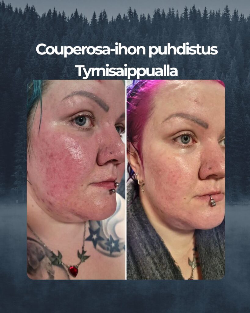 Kuvapalaute: Minulla on couperoottinen ja kuiva iho johon tullee varsinkin alaleuan alle finnejä. Oon hävennyt aina sitä kun olen punainen kuin rapu saunan, pakkasen tai auringon paisteen jälkeen. Enkä ikinä ole oikein tienny mistä saisin oikeasti apua varsinkin tähän punoitukseen. Päätin kokeilla googlettelujen ja arvostelun lukujen jälkeen Saaren Taian Tyrni Luksus Spa saippuaa, Appelsiini Kamomilla Aloe kasvovettä ja Rauhoittavaa hoitovoidetta punaiselle iholle. En olis ikinä uskonut, että näin nopeasti näkyy tuloksia. Iho tuntuu pehmeeltä eikä enään otsastakaan tunnu kuivalta + näpyt on alkanut pienentyä myös leuan alla. Kuvien välissä on vain VIIKKO tuotteiden käyttöä. Mitä parasta, en ole enään niin Rapu 🤩 Vielä pitää lisätä Kiitokset teille ja teidän ihonhoito tuotteille. Ootte ihoni pelastus.