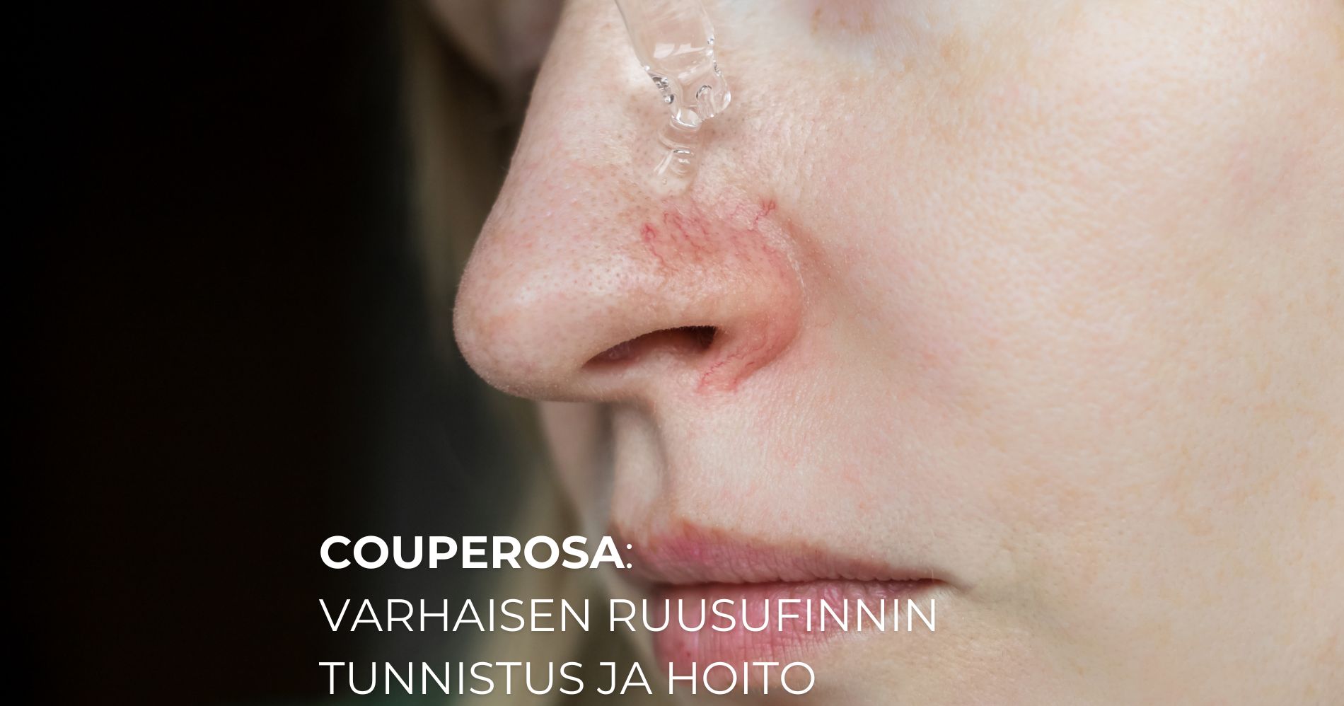 Couperosa ja varhaisen ruusufinnin tunnistus ja hoito