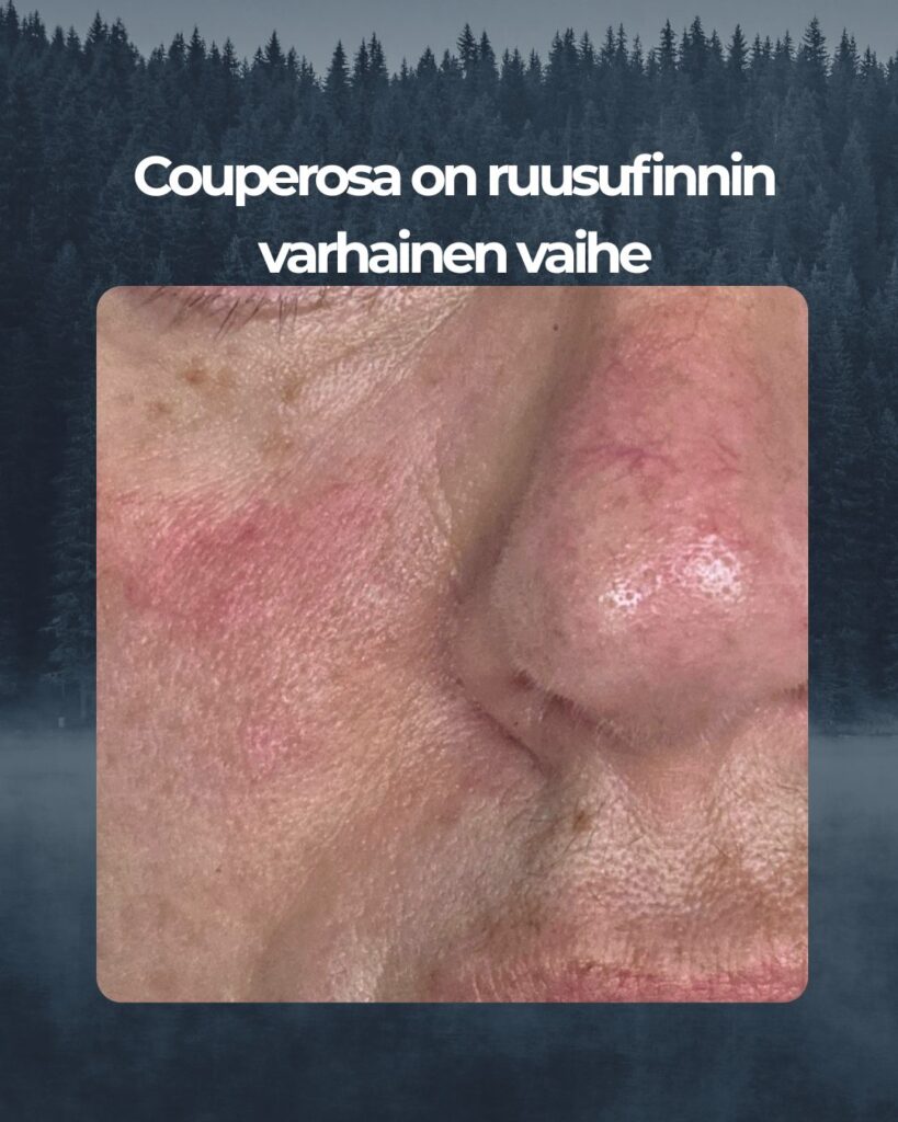 Couperosalle tyypillisiä verisuonia näkyvillä nenän alueen iholla