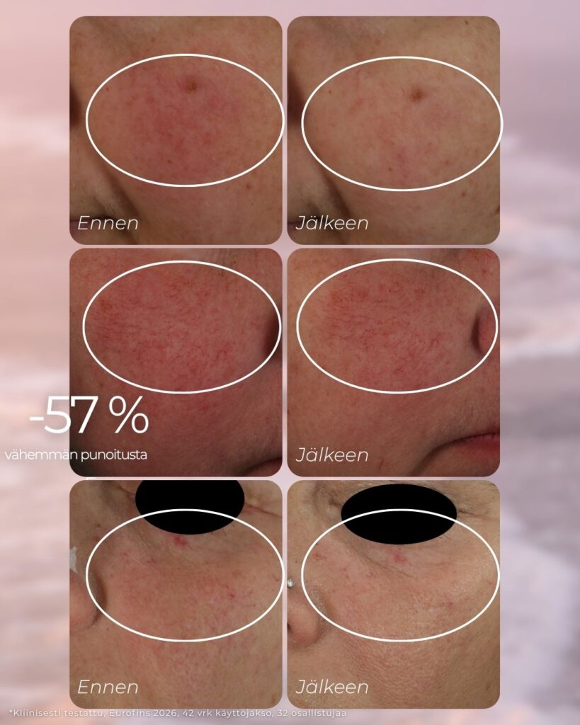 Punoitusta rauhoittava suojamuuria vahvistava seerumi on kehitetty erityisesti ruusufinniin ja couperosaan taipuvalle iholle. Se on kliinisesti testattu dermatologin valvonnassa: punoitus väheni 57 %