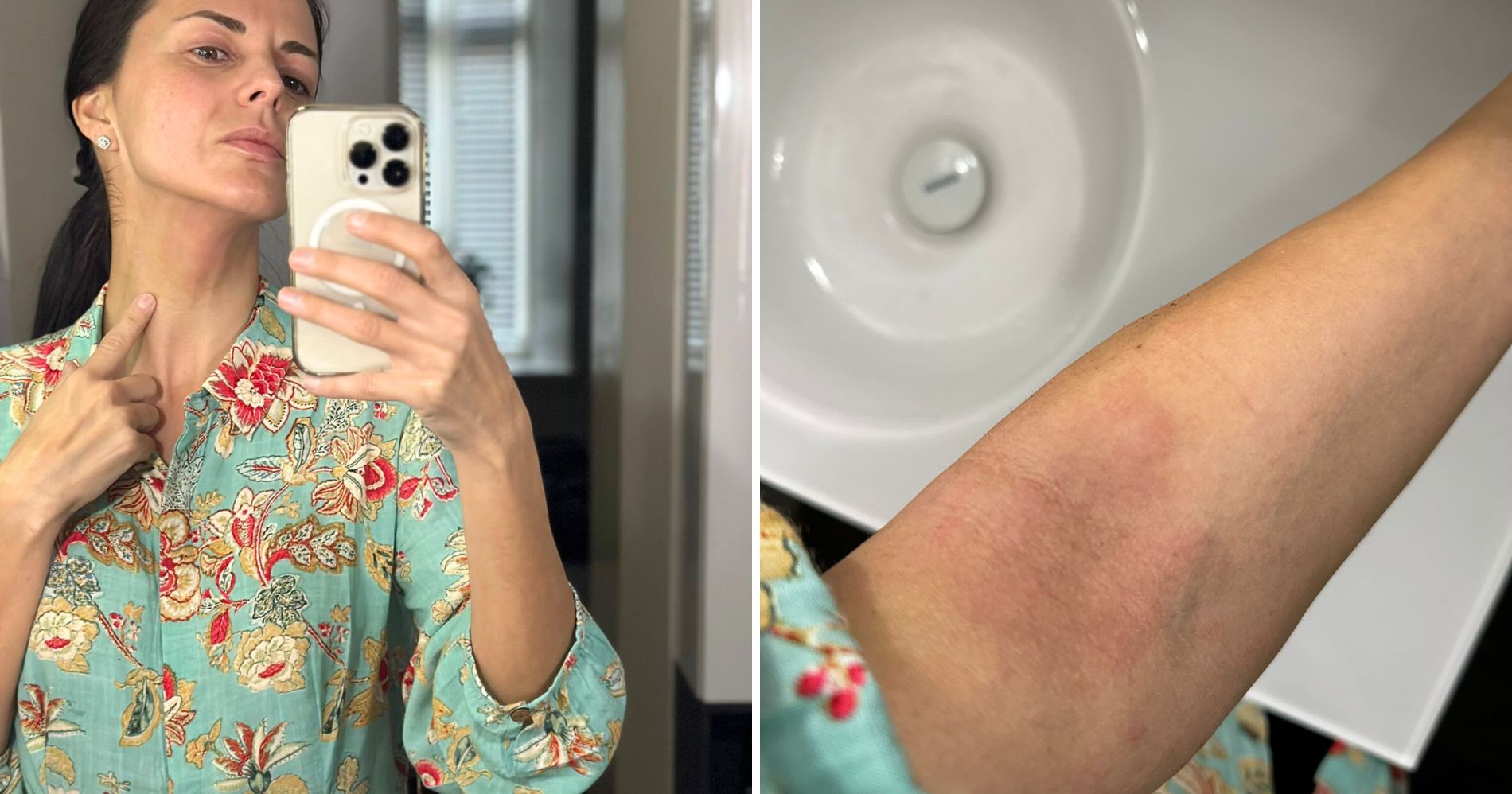 Satu Tuomisto kertoo arjen haasteistaan atooppisen ihottuman kanssa