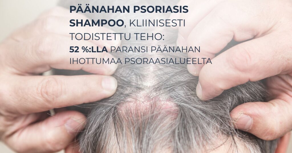 Päänahan psoriasis shampoo, kliinisesti todistettu teho: 52 %:lla paransi päänahan ihottumaa psoraasialueelta