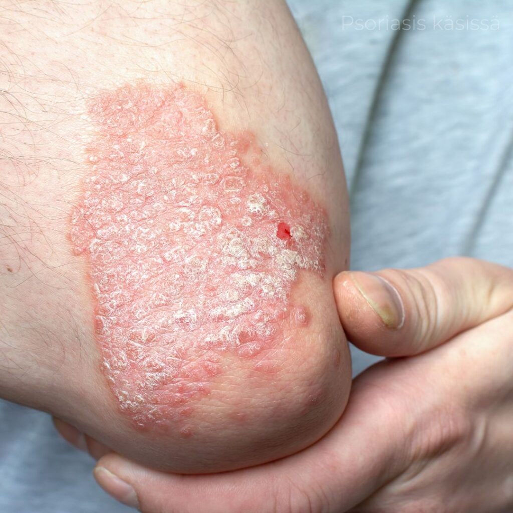 Psoriasis käsissä
