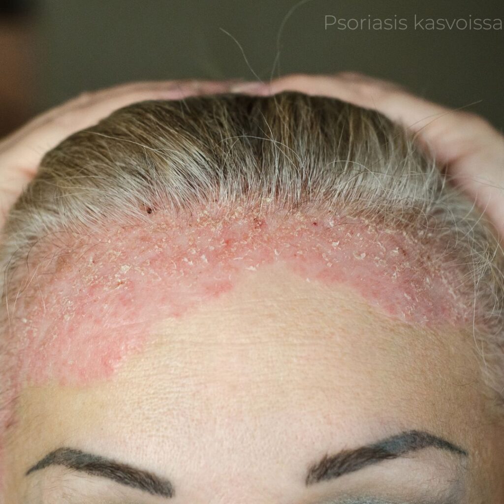 Psoriasis kasvoissa