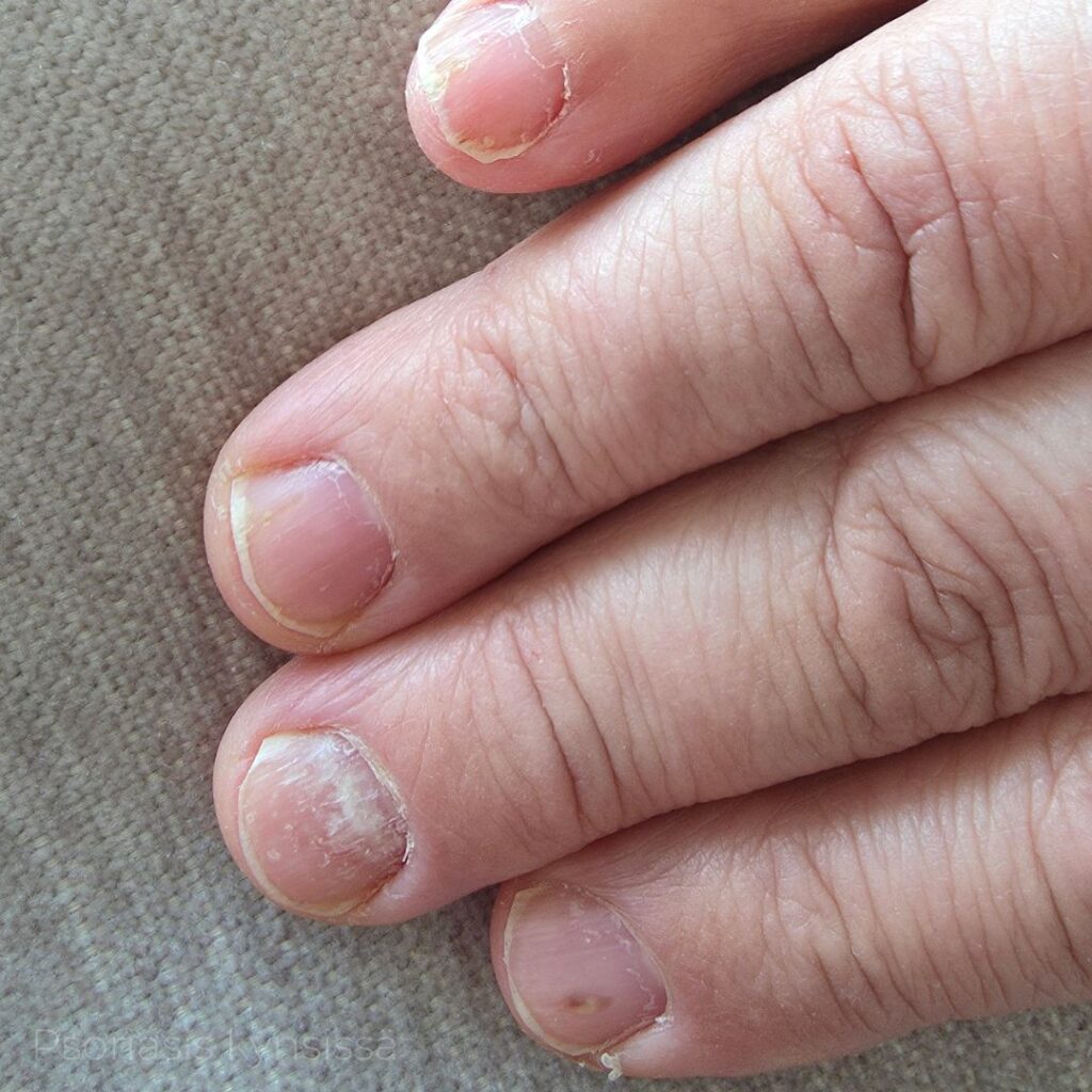Psoriasis kynsissä