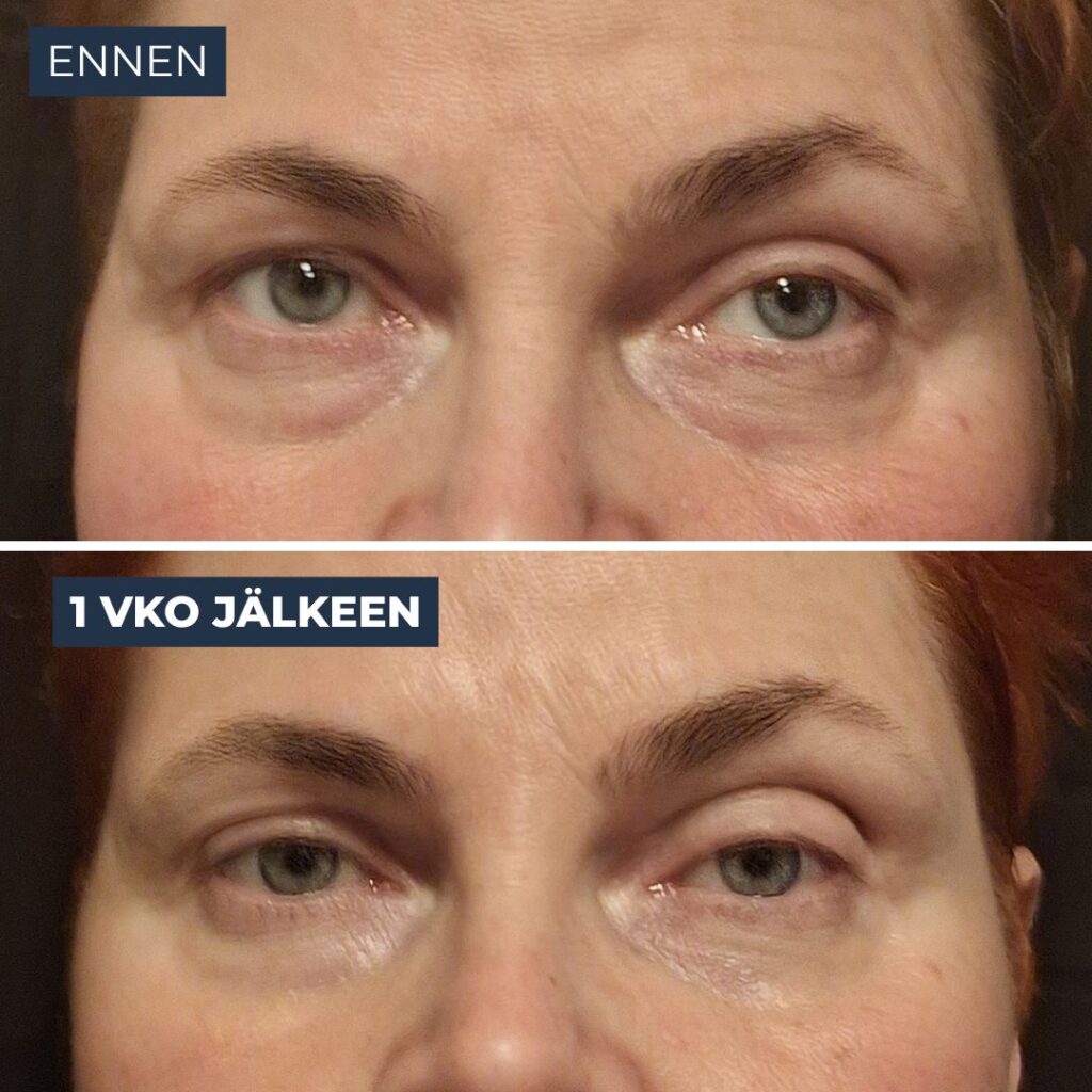 Rakkohauru silmänympärysvoide roll-on kokemuksia
