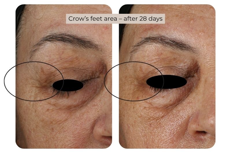 Clinical study super serum Crow’s feet area