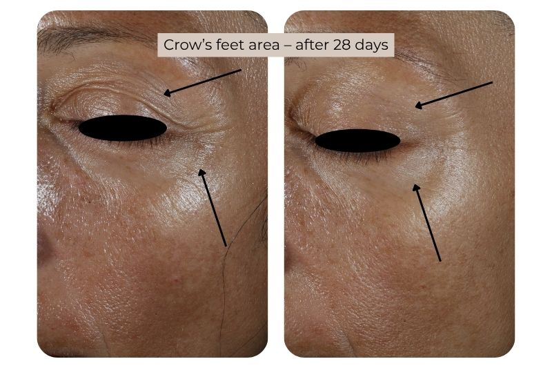 Clinical study super serum Crow’s feet area