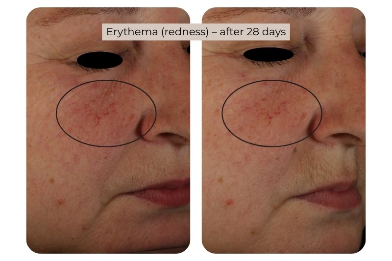 Clinical study super serum Erythema (redness)