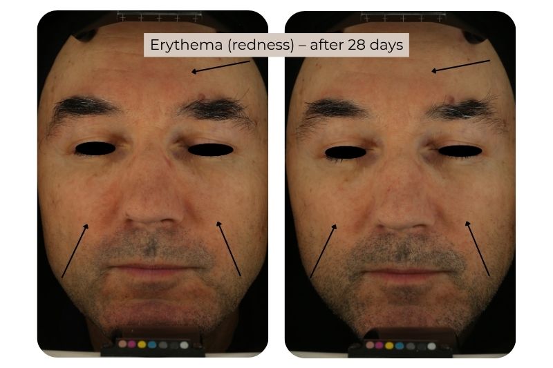 Clinical study super serum Erythema (redness)