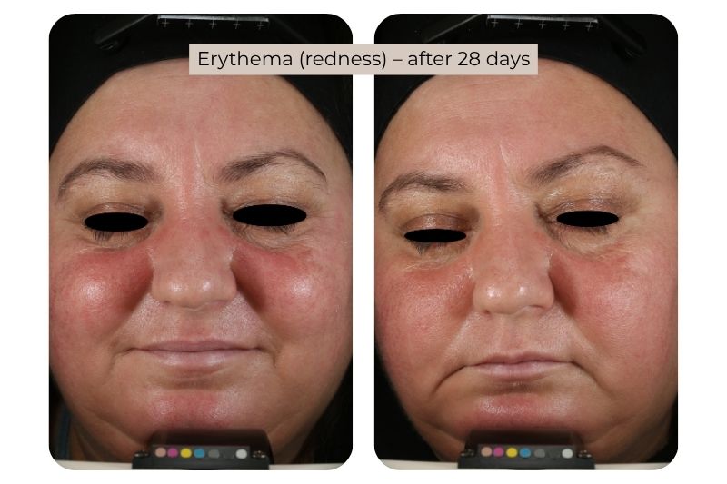 Clinical study super serum Erythema (redness)