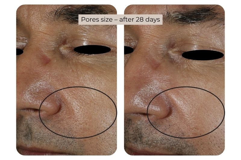 Clinical study super serum Pores size