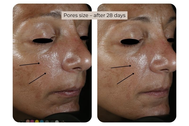 Clinical study super serum Pores size