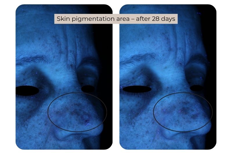Clinical study super serum Skin pigmentation area