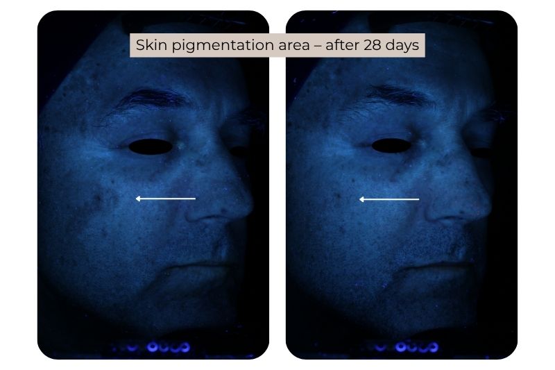 Clinical study super serum Skin pigmentation area