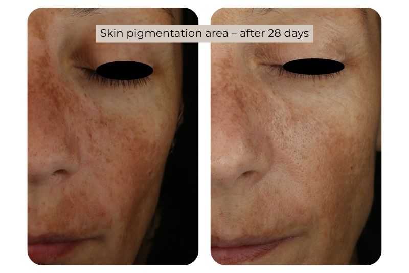 Clinical study super serum Skin pigmentation area