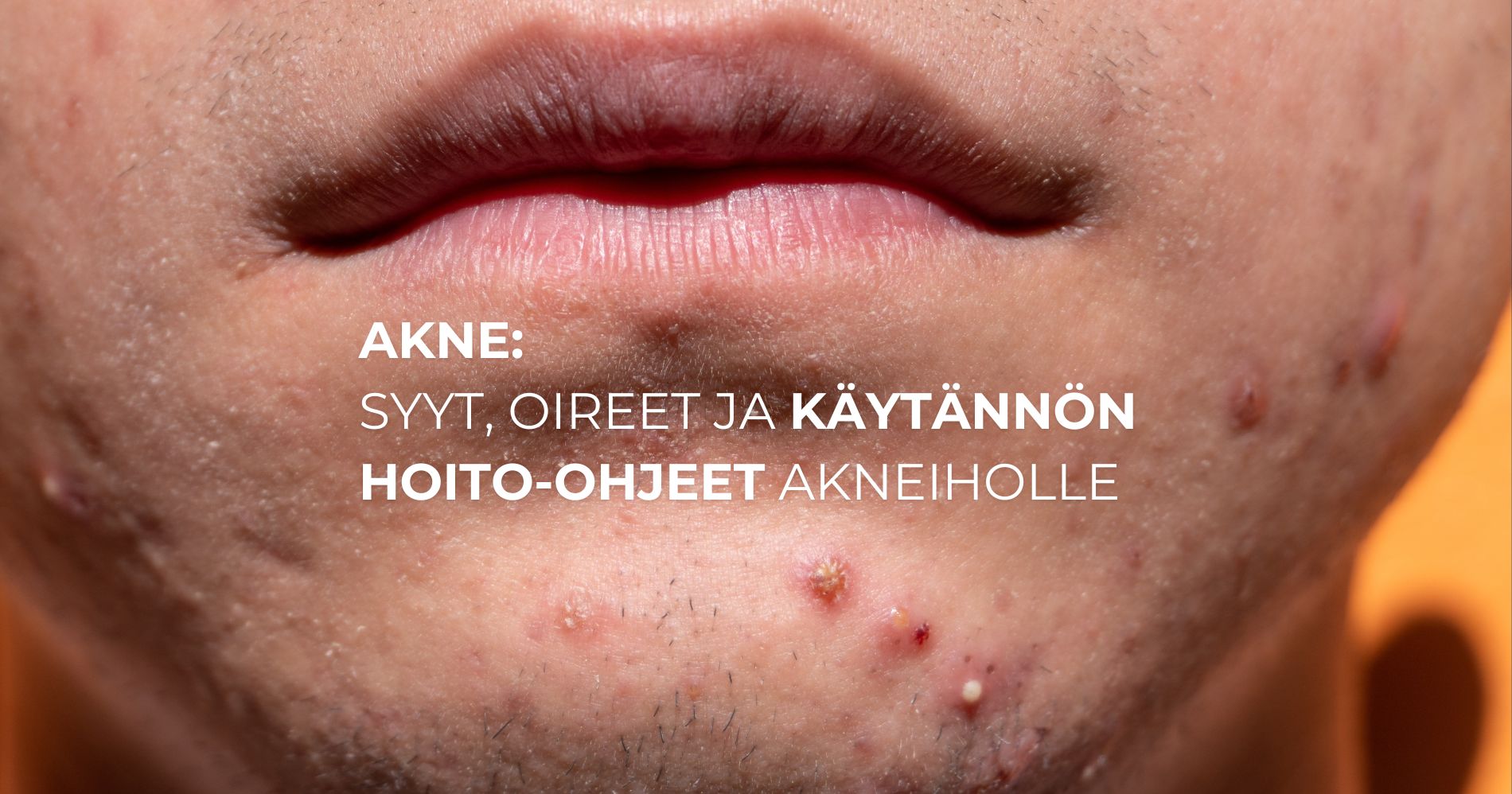 Akne: syyt, oireet ja käytännön hoito-ohjeet akneiholle