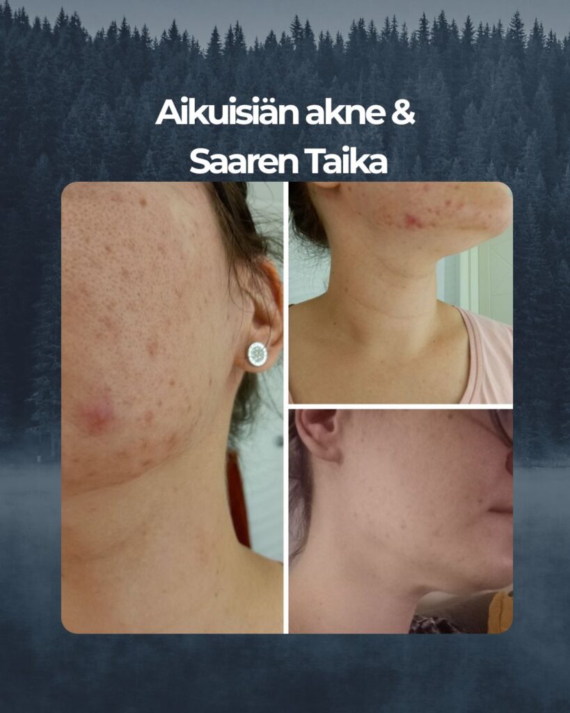 Kuvapalaute: Olen kärsinyt aikuis-iän aknesta, vaikka luulin aknen jäävän teinivuosien mukana taaksepäin. Lisäksi minulla on kovin herkkä ja pintakuiva iho. Teepuusaippua on ollut pelastus kasvojeni iholle. Olen pessyt kasvot iltaisin Teepuusaippualla, (käytössä ollut sekä nestemäinen että palasaippua, palasaippua minun lemppari). Iho parantunut huomattavasti. Vanhoja arpia toki on, mutta ihoni on paremmassa kunnossa kuin aikoihin. Uusia finnejä tulee todella vähän ja jos tulee niin ihan yksittäisiä vain jotka nopeasti kuivuvat saippuan käytöllä pois. Kiitos, olen saanut kasvoni takaisin!