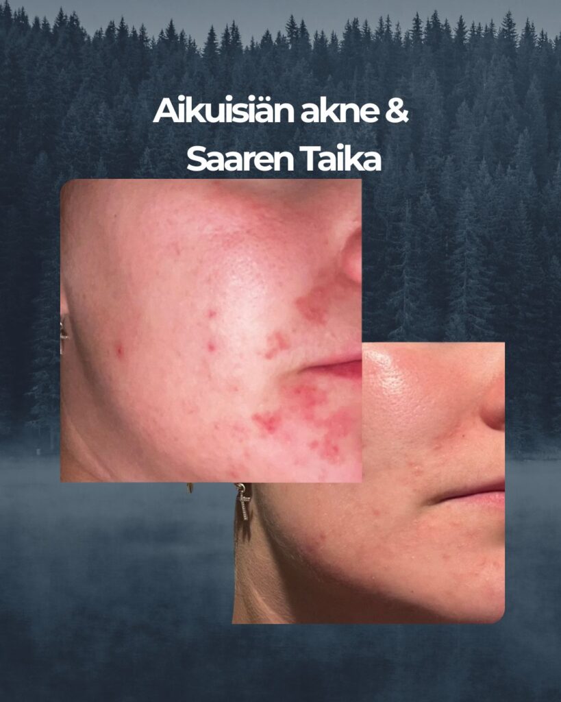 Kuvapalaute: En koskaa ois uskonu et laittasin tälläsii kuvii mihinkää, mut nyt on kyllä pakko!! Oon kärsiny pitkään aikuisiän aknesta. Ainoo tuote mikä on OIKEESTI auttanu on teepuusaippua!! Alotin käyttää teepuusaippuaa ihan lokakuun alusta. ENNEN—> Kuva otettu 2.-4.10.22.