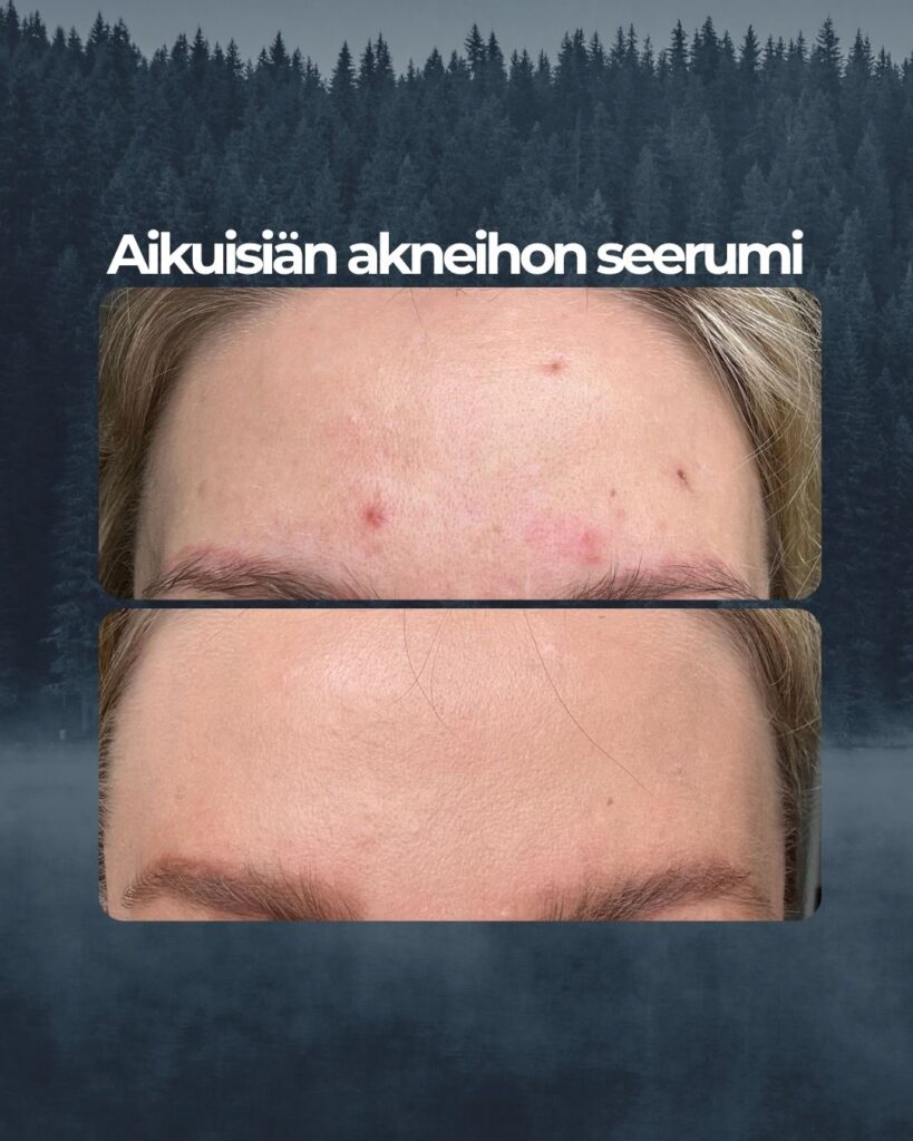 Kuvapalaute: Azelaic Acid viikon käytöllä! Mun jostain räjähtänyt otsa on pelastettu. Kuivatti finnit ja vei jäljet hetkessä pois! Best. Ei varmasti tarvitse kertoa kumpi on enne ja kumpi jälkeen.