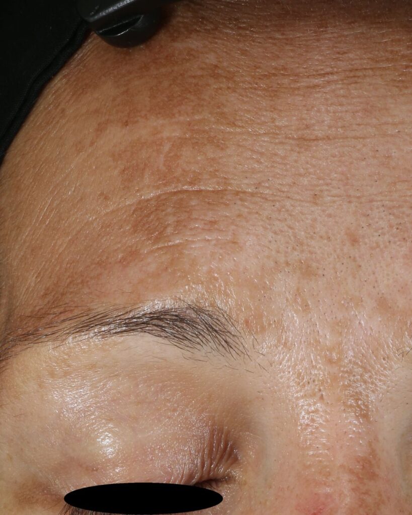 Maksaläiskä eli melasma iholla, ruskehtava pigmenttimuutos.