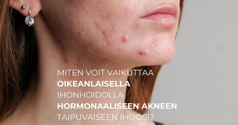 Miten voit vaikuttaa oikeanlaisella ihonhoidolla hormonaaliseen akneen taipuvaiseen ihoosi?