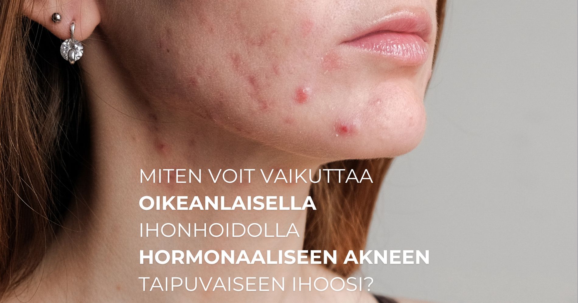 Miten voit vaikuttaa oikeanlaisella ihonhoidolla hormonaaliseen akneen taipuvaiseen ihoosi?