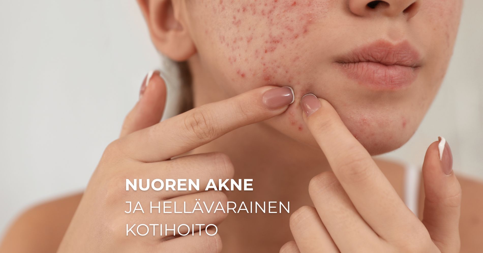 Nuoren akne ja hellävarainen kotihoito