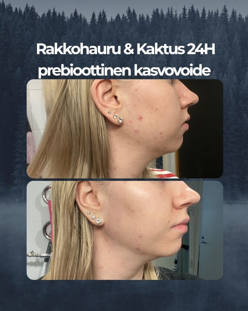 Paras voide aikuiselle akneiholle