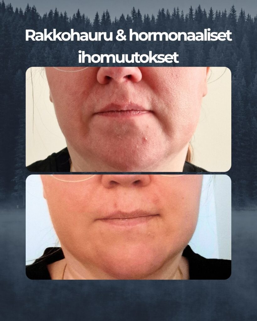 Kuluttajatutkimuksessa 25 % epäpuhtauksista kärsineistä koki epäpuhtauksien iholla vähentyneen