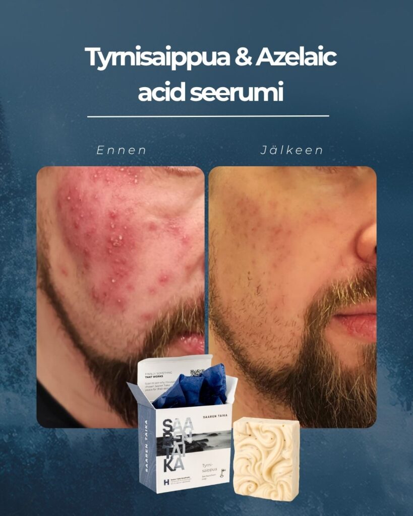 Asiakkaan ennen jälkeen kuvat Saaren Taika Tyrnisaippuan ja Azelaic acid seerumin käytöstä ruusufinni iholla