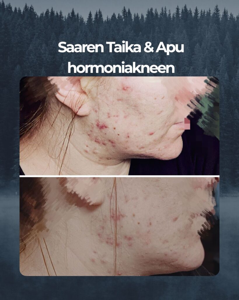 Kuvapalaute: Käytössä siis Saaren Taika Teepuusaippua. Kasvoni ovan pintakuivat ja ihoni on herkkä. Mikään muu pesuaine ei ole toiminut omalle iholle. Itsellä erittäin paha hormonaalinen akne, jolloin aina ovulaation ja kuukautisten aikaan on pahoja kipeitä finnejä, osa ei edes puhkea, vaan jää todella pitkiksi ajoiksi kipuilemaan kasvoille. Etenkin leuan ja kaulan alueelle. Tässä kuvien oton välissä on kaksi päivää. Selkeästi on alkaneet laskemaan ja punoitus rauhoittunut. Todella tyytyväinen ja iloinen, kun toimivuus on näin hyvä. Kiitos teille.