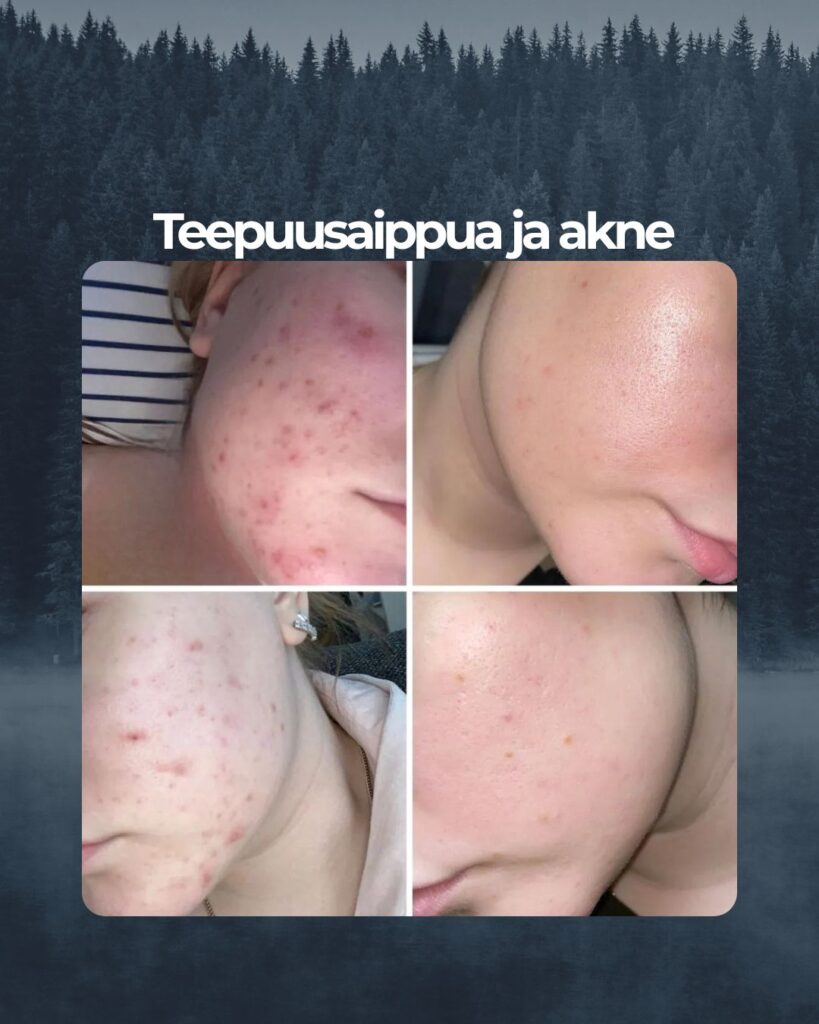 Kuvapalaute: Moikka! Ajattelin pistää teille kuvia siitä kuinka hyvin teidän Saaren Taika Teepuusaippua on auttanut minua todella pahassa aknessa. Vuoden olen käyttänyt teidän Teepuusaippuaa, enkä vaihtaisi sitä kyllä enään mihinkään muuhun. Kaikkea apteekki tuotteista marketti tuotteisiin on tullut testattua, mutta tämä saippua pelasti naamani. Olen tässä ollut ihan ihmeissään, että miten tämä on mahdollista ja aloin jo uskoa, että aknesta en pääse ikinä eroon. Plussaa on myös, että teepuusaippua on todella riittoisaa ja kestää pitkään!