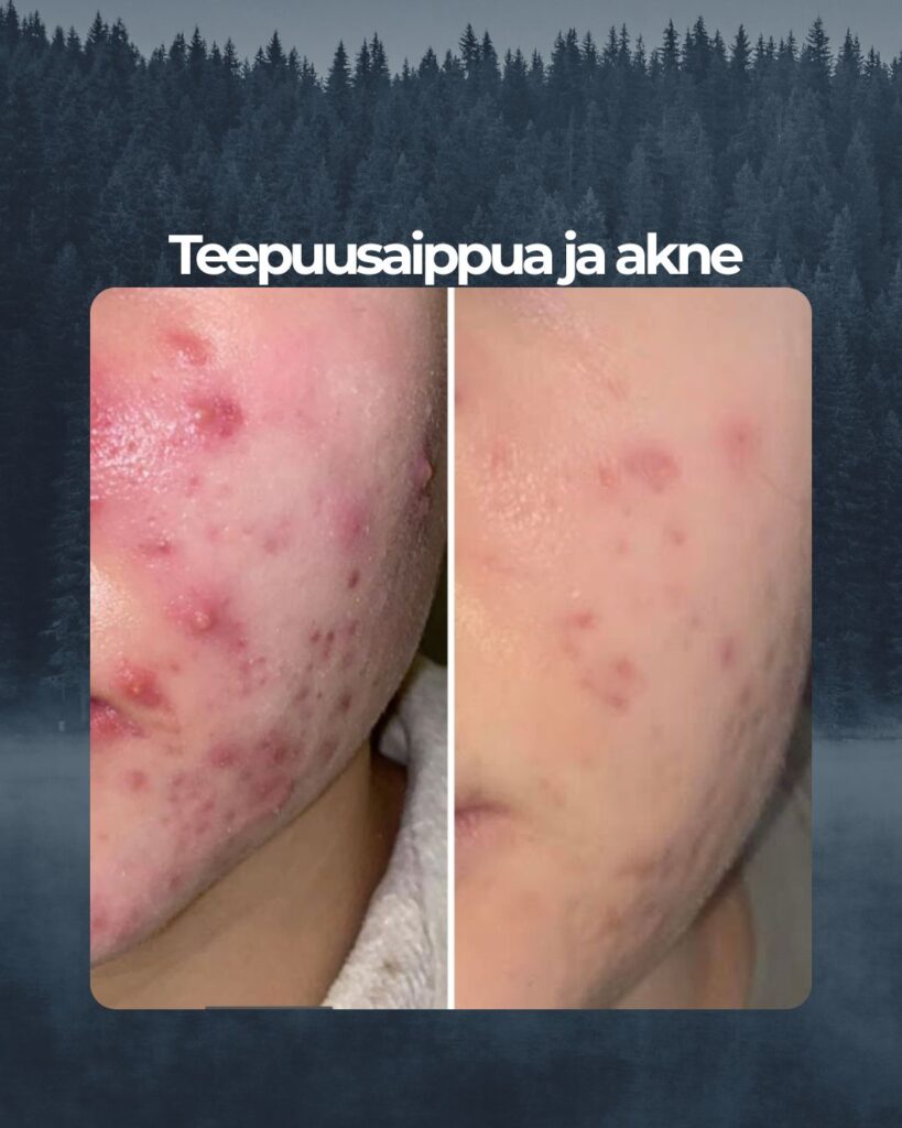 Kuvapalaute: ”Hei! Olen käyttänyt Saaren taika Teepuusaippuaa kohta kuukauden ja olen erittäin tyytyväinen tähän tuotteeseen, sillä se on auttanut akneen todella hyvin. Mikään muu tuote ei ole auttanut. Kiitos tästä mahtavasta tuotteesta!”