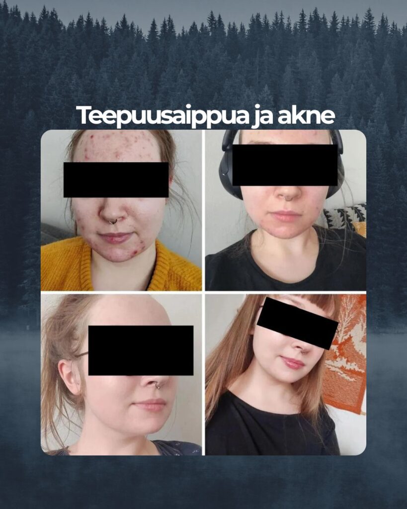 Kuvapalaute: ”Kun lopetin e-pillerit, alkoi naamaan vähitellen ilmestyä joka kuukausi aina vaan enemmän ja enemmän finnejä. Akne alkoi olla todella kipeä ja ikävän näköinen. Teesaippuan ansioista olen vihdoin saanut takaisin kauniin tasaisen ihoni ja vielä yllättävän lyhyellä aikavälillä, vain n. 2kk. Itsevarmuus ja elämänilo on taas palannut kiitos teepuupalasaippuan! Kiitos Kiitos ! Teepuupalasaippuaa olen käyttänyt jokapäivä, aamuin ja illoin.”