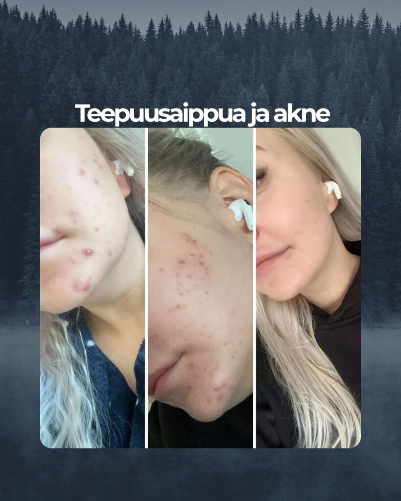 Kuvapalaute: Hei, ennen Saaren Taika Teepuusaippuan ostoa kärsin vuosia pahasta aknesta, lääkekuurit auttoivat vain hetkellisesti ja sivuoireet näistä olivat kamalia. Finnit olivat kipeitä ja itsetuntoni kärsi näistä suuresti. Huomasin saippuan vaikutuksen ihooni jo hyvin nopeasti, nyt ihoni voi hyvin ja arvetkin vanhoista finneistä ovat alkaneet kaikota. Aivan paras tuote, suosittelen ehdottomasti❤️