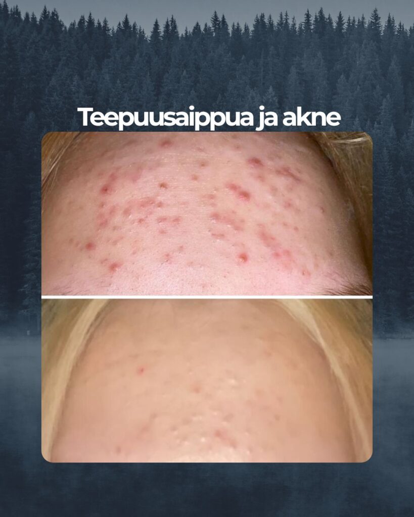 Kuvapalaute: Hei, olen käyttänyt nyt Saaren Taika Teepuusaippuaa sekä Salisyylihappo tehovoidetta noin 3 kk ja haluan antaa teille kiitoksen ja palautetta mahtavista tuotteista, joista on ollut iso apu akne iholleni.