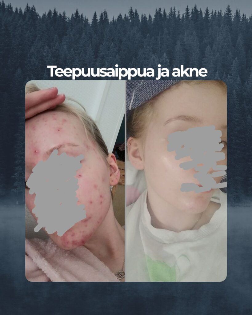 Kuvapalaute: Kaksi kuvaa naamastani, välissä on noin puolisen vuotta.. Nyt puolen vuoden aikana käytössäni on olleet päivittäin teepuusaippua, spot control sekä salisyylihappo tehovoiteet näpyille. Ainoat tuotteet, jotka ovat oikeasti toimineet tähän mennessä akneiholleni.. Ei voi sanoa muutakuin iso Kiitos!