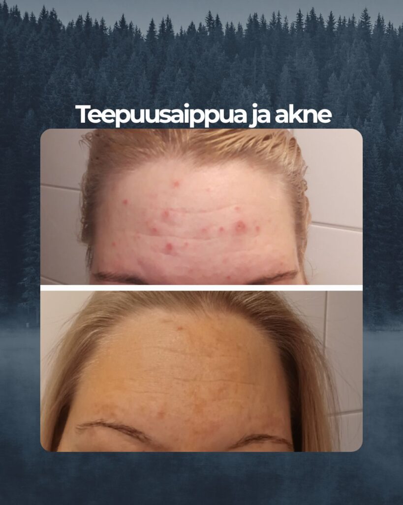 Kuvapalaute: Tässä oma tarinani teepuusaippuasta. Kiitos kun olette olemassa 🙏 Minulla on ollut teini-iästä lähtien akneiho. Ehkäisypillerien lopetus laukaisi myös aikuisiän aknen. Vuonna 2010 söin ensimmäisen isotretinoin kuurini joka paransi aknen. Akne uusiutui vuonna 2019 jolloin kuuri oli uusittava. Apu ei kuitenkaan kestänyt kauaa. En halunnut enää sitä vahvaa kuuria ja kokeilin teidän teepuusaippuaa. Kuvassa ylhäällä lähtötilanne ja ensimmäiset tulokset näkyivät jo 2 viikon kohdalla. Sen jälkeen akne on pysynyt poissa ja ollut rauhallinen. Minulla kestää 1 palasaippua vuoden. Nyt alkaa olla toinen saippua jo lopuillaan. Meinasin seuraavaksi kokeilla aktiivihiili teepuusaippuaa. Kuvassa alhaalla tänään otettu kuva otsastani.